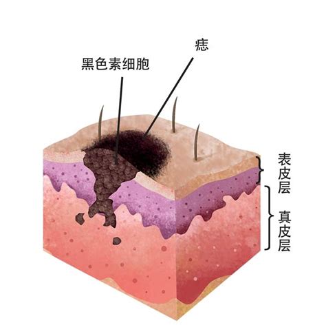 黑痣的形成|痣形成的原因？痣長毛、痣變多變大是痣病變？5招判。